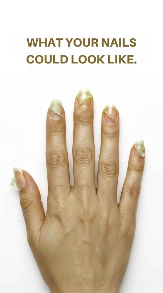 Peeling Damaged Nails Before Healthy Nail Habits